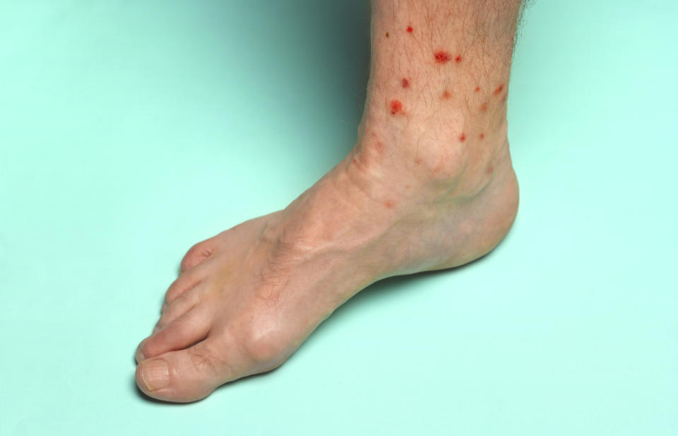 Adult man's naked foot covered with red raw insect bites