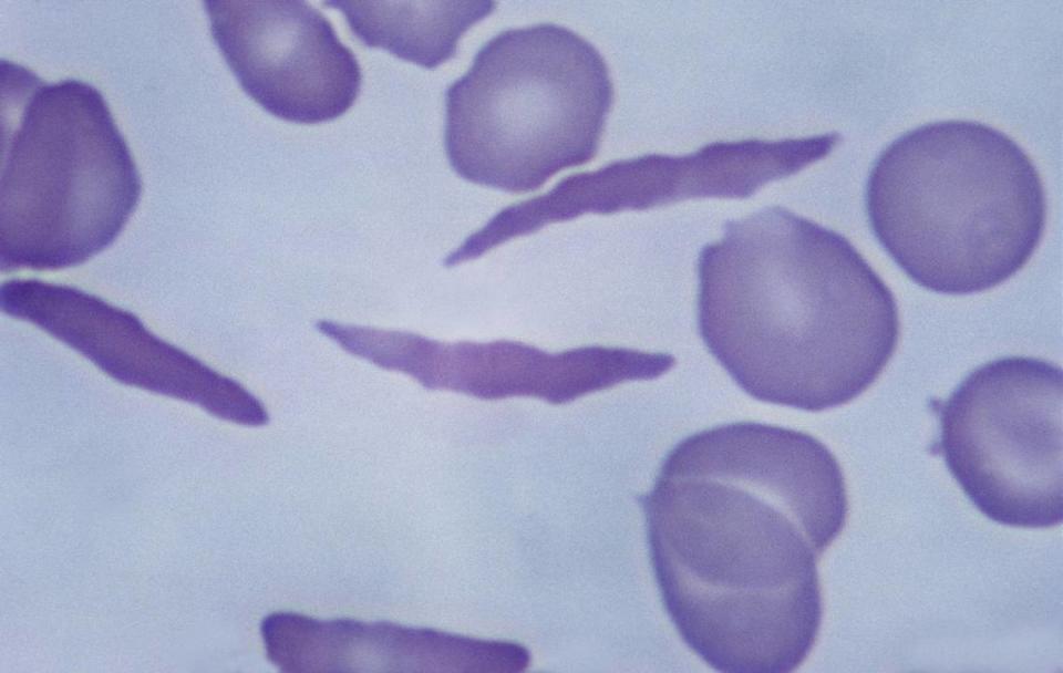 Sickle cell anemia. Distorted or sickled cells, 640X at 35mm. Shows 3 severely distorted or sickled cells. Sickled cells may block small blood vessels. Hereditary disease that produces an abnormal hemoglobin.