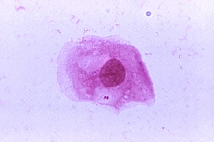 Neisseria meningitidis.