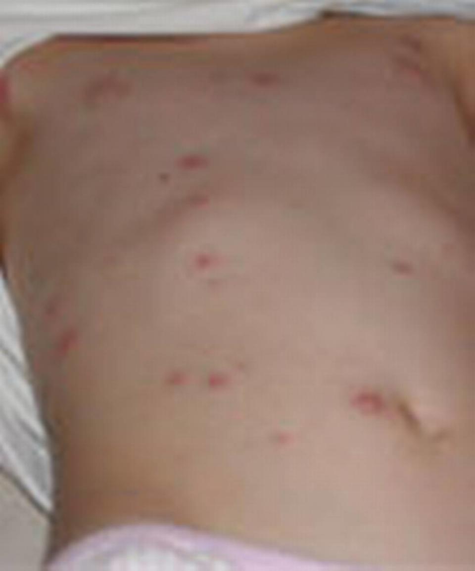 A vaccinated case of chickenpox that appears milder with less rash.