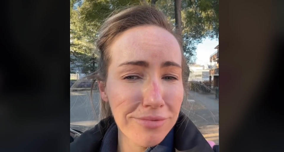 A NSW emergency department nurse has shared a video showing the harrowing effect of wearing full PPE for 12 hours straight. Source: TikTok/injector_chronicles