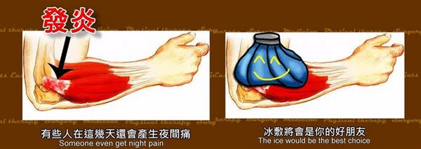 急性期主要目標是要降低發炎反應，冰敷將會是你的好朋友。（圖片／擷取自Sunguts youtube影片）