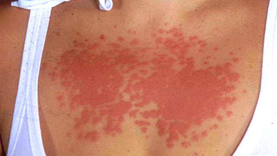 Sun poisoning (mayoclinic.org)