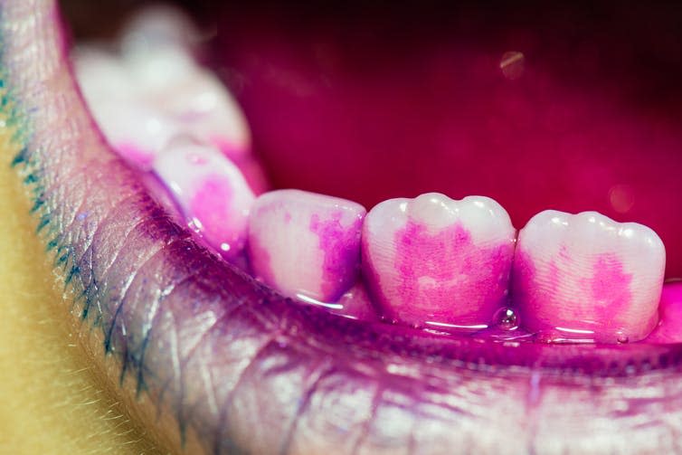 <span class="caption">Invisible plaque is revealed in bright pink after using a disclosing tablet.</span> <span class="attribution"><a class="link " href="https://www.shutterstock.com/image-photo/dental-plaque-visible-red-pill-1123678601?src=yMT5KTPVa4PGN0OB7Dyf8w-1-2" rel="nofollow noopener" target="_blank" data-ylk="slk:Weakiva/Shutterstock;elm:context_link;itc:0;sec:content-canvas">Weakiva/Shutterstock</a></span>