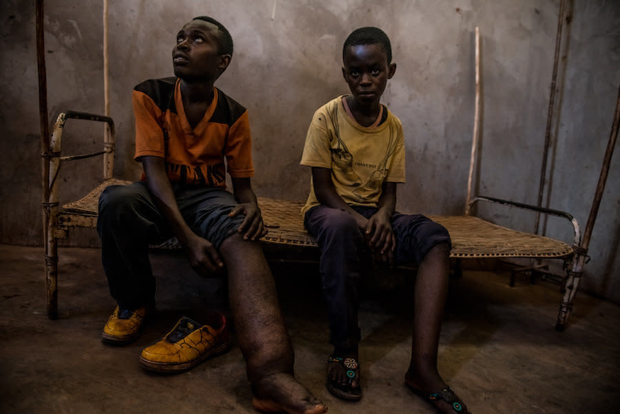 Two elephantiasis patients wait to meet with a traveling medical team in Uma. (Photo: Neil Brandvold/DNDi)