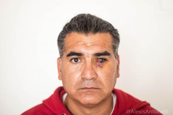 Albano Toro Cardenas says he was shot in the eye by security forces (Naomi Larsson/The Independent)