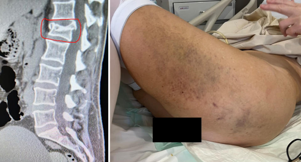 Left, the X-ray showing the nurse's fractures. Right, Linda Dehnert-Rowe feared paraplegia with her huge bruise on the back of her legs. 