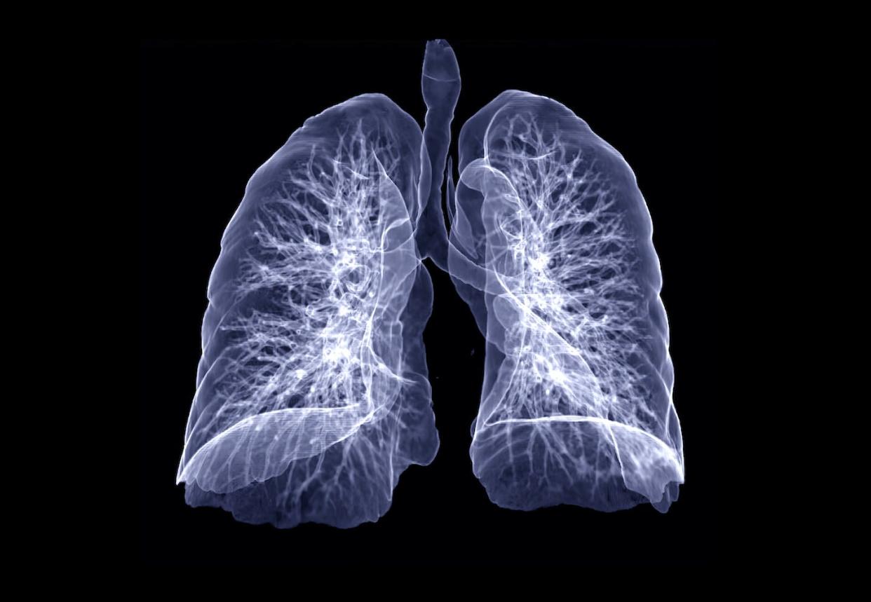 Lung disease can manifest in a number of ways. <a href="https://www.gettyimages.com/detail/photo/lung-3d-rendering-imaging-royalty-free-image/1214718462" rel="nofollow noopener" target="_blank" data-ylk="slk:Mr. Suphachai Praserdumrongchai/iStock via Getty Images Plus;elm:context_link;itc:0;sec:content-canvas" class="link ">Mr. Suphachai Praserdumrongchai/iStock via Getty Images Plus</a>