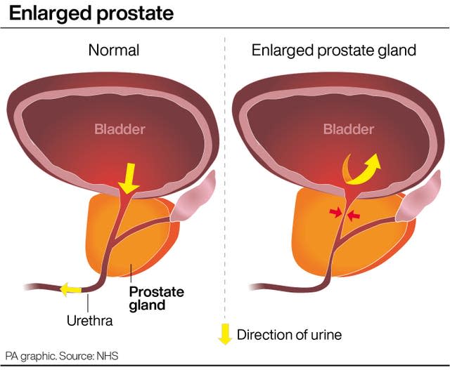PA infographic showing an enlarged prostate