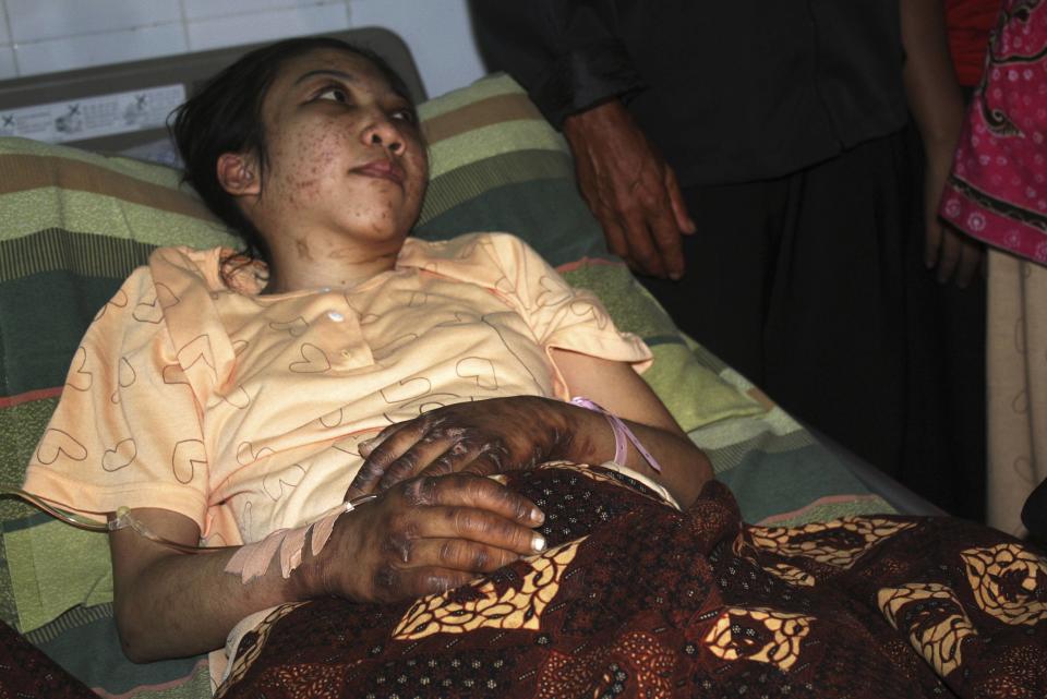 Indonesian domestic helper Erwiana Sulistyaningsih lies in a bed whilst being treated at a hospital in Sragen, Indonesia's Central Java province January 17, 2014. Thousands of people rallied in Hong Kong on Sunday to demand justice for Erwiana, who was badly beaten by her employer in a case that has sparked widespread outrage and a police investigation into accusations of torture. Erwiana had suffered extensive injuries but her condition was stabilising, a hospital spokesman said. Picture taken January 17, 2014. REUTERS/Stringer (INDONESIA - Tags: HEALTH)