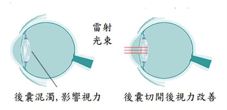 白內障術後後囊混濁(左) 經雷射後囊切開術後(右)（圖片提供／亞東醫院）