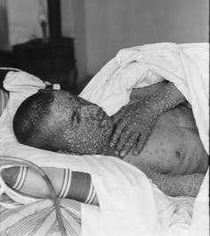 <span class="caption">Smallpox was finally eradicated in 1980.</span> <span class="attribution"><a class="link " href="https://www.shutterstock.com/image-photo/heavily-pockmarked-face-arms-hands-smallpox-242815531" rel="nofollow noopener" target="_blank" data-ylk="slk:Everett Historical/Shutterstock;elm:context_link;itc:0;sec:content-canvas">Everett Historical/Shutterstock</a></span>