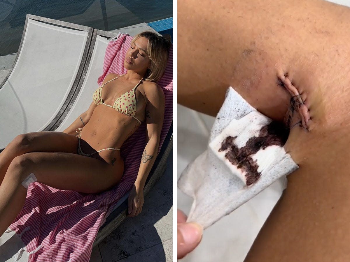 Tammy Hembrow tanning on left; Tammy Hembrow showing her melanoma surgery stitches on right