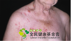 帶狀疱疹會於身體軀幹的單側出現一排或一片水泡。