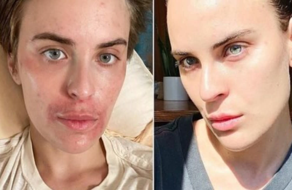 Tallulah Willis has shown off the dramatic “healing” she has experienced from her skin picking disorder credit:Bang Showbiz