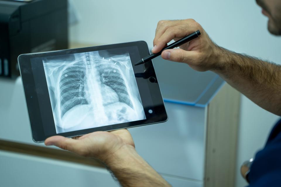 Chest x-ray shows a lung infection.