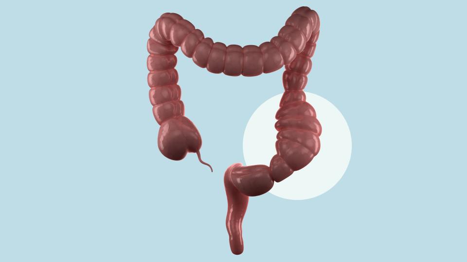 <p>This happens when your small or large intestines are unable to move things along due to a mechanical or physical blockage, or even a change in the motility function of your bowels, Dr. Skeans says.</p> <p>Symptoms usually include having abdominal pain, bloating, abdominal distention, nausea, and vomiting. Plenty of things can cause a bowel obstruction, including having a tumor, inflammation, or a surgical complication. You definitely don’t want to let a bowel obstruction slide. “It can be life-threatening if there is a complete obstruction and can even require surgery,” Dr. Skeans says.</p>