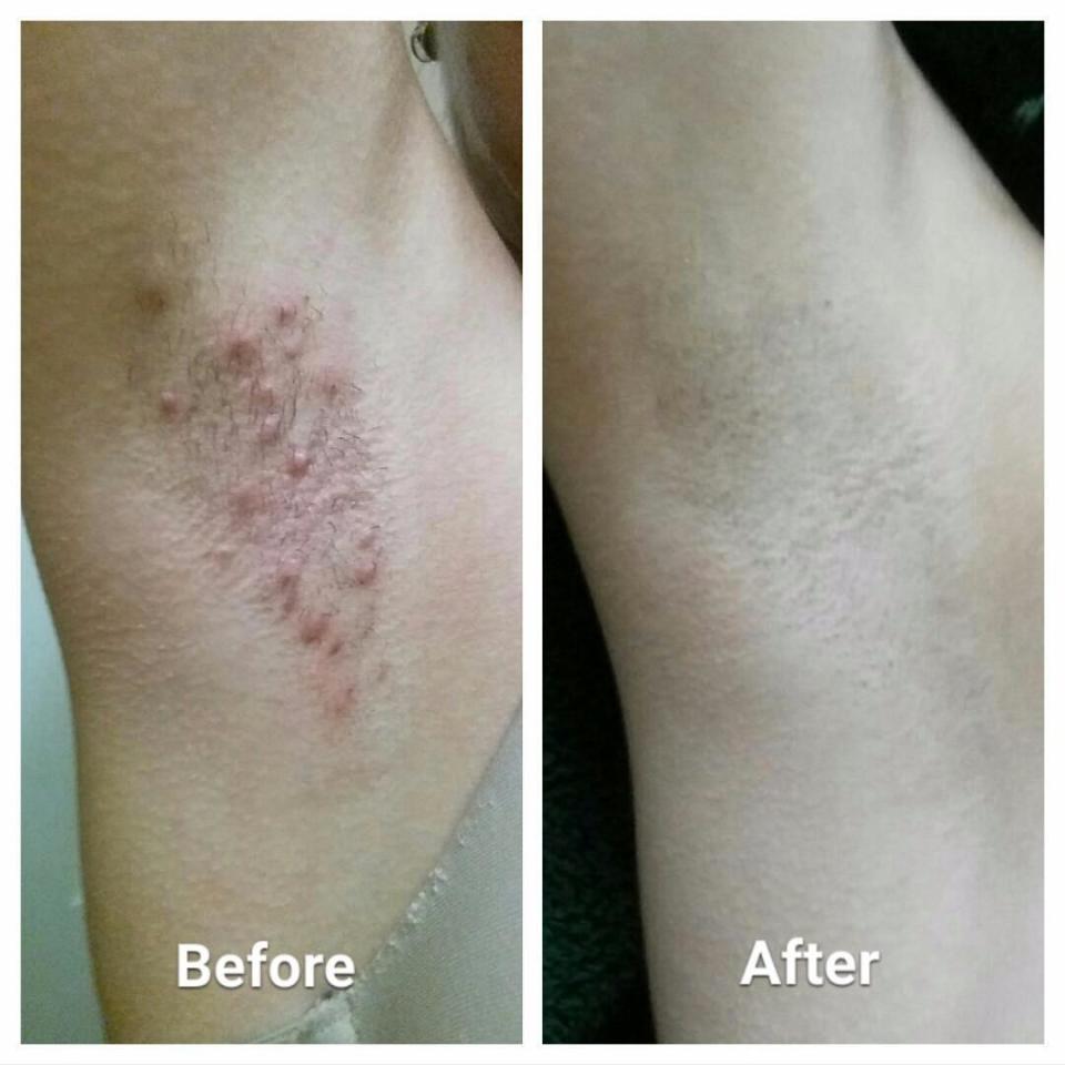 A before/after of the same armpit; before with large inflamed bumps, the after shaved with no bumps at all