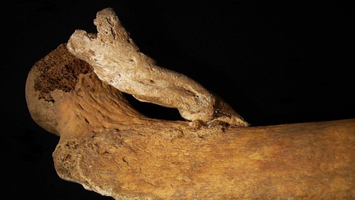  A picture of the femur bone with the 3-inch bone growth. 