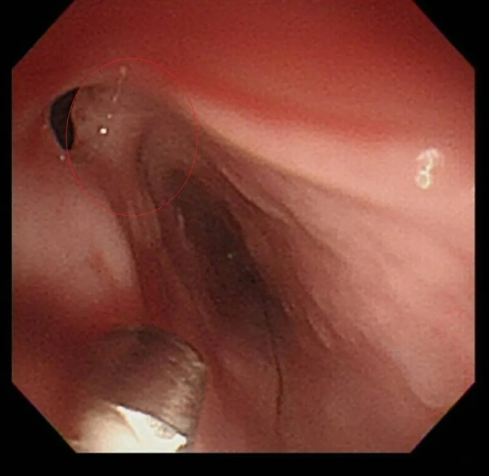 內視鏡下的食道腫瘤（紅圈處）。彰化醫院提供