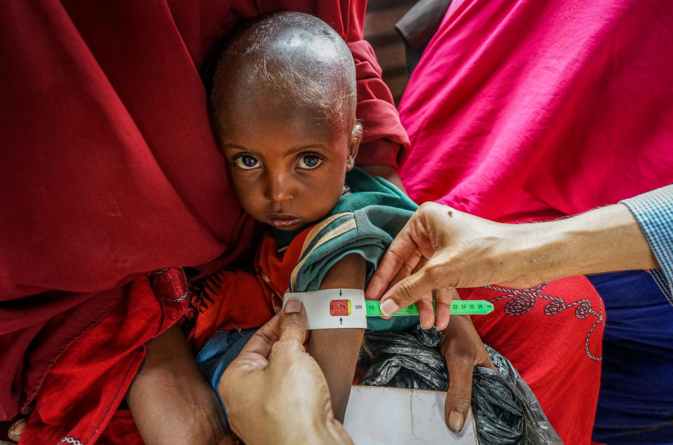 A child is measured for malnutrition in the Outpatient Therapeutic Program area of a UNICEF/USAID-supported health facility in Doolow. (Giles Clarke)