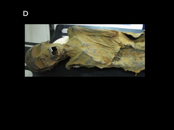 A CT scan of a mummified, mid-forties woman who lived in what is now Peru between 1100 and 1800 years ago revealed evidence of narrowed arteries.