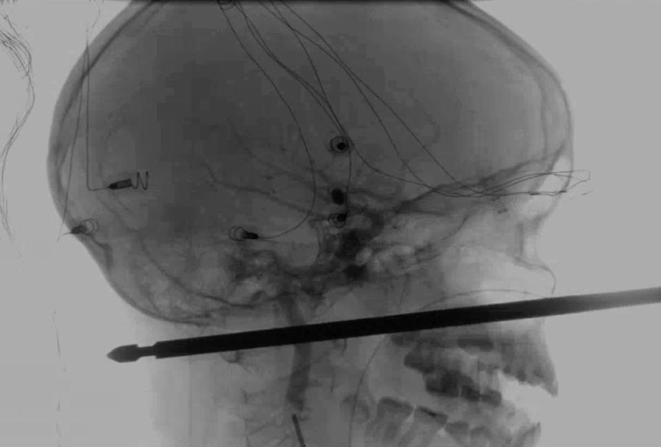 <em>An X-ray shows how a meat skewer impaled in the skull of Xavier Cunningham after he fell from his tree house (AP)</em>