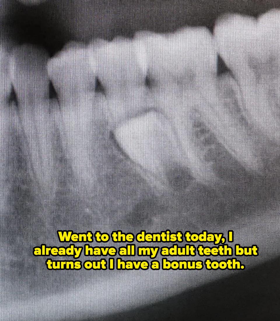 Dental X-ray showing teeth and jawbone