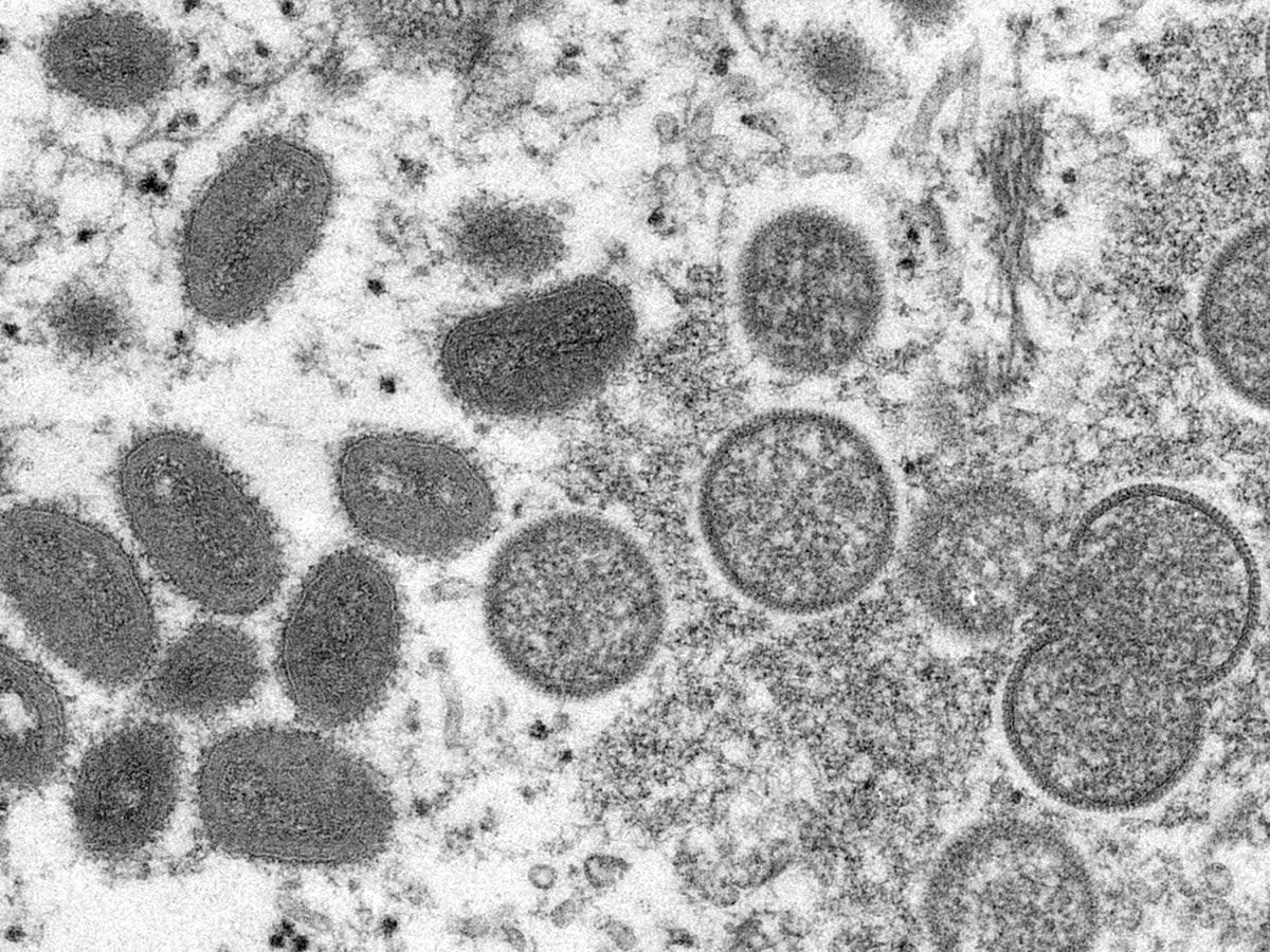 People have been urged to avoid sex from the first sign of monkeypox symptoms (Cynthia S Goldsmith, Russell Regner/CDC via AP)