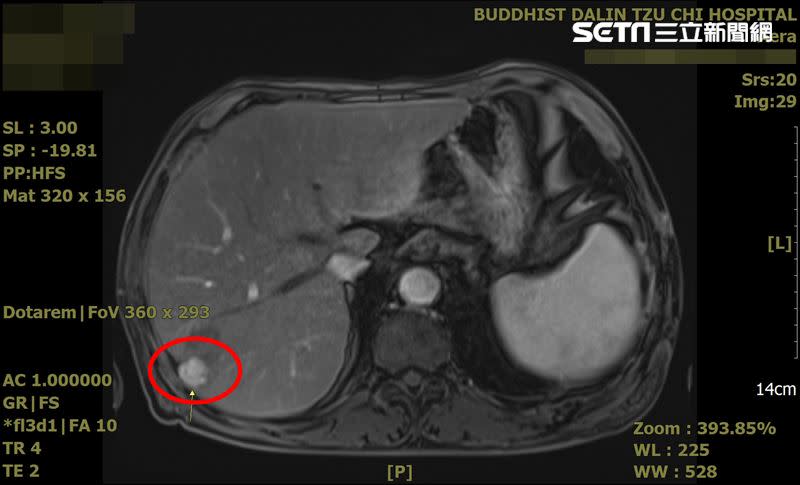紅圈處為肝腫瘤位置（圖／大林慈院提供）