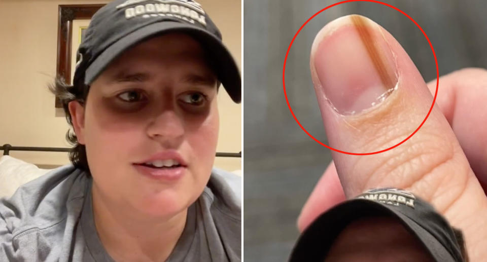 Maria Sylvia on TikTok showing the brown line on her thumbnail, which turned out to be cancer.