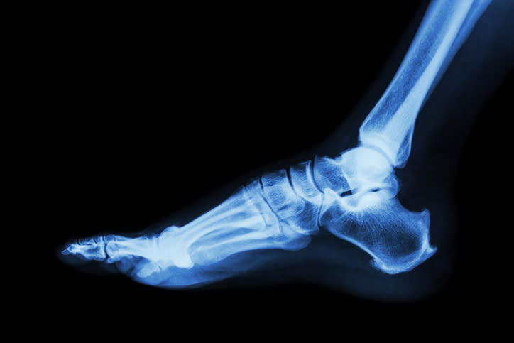 X-ray image showing the side view of a human foot, highlighting bones and joints