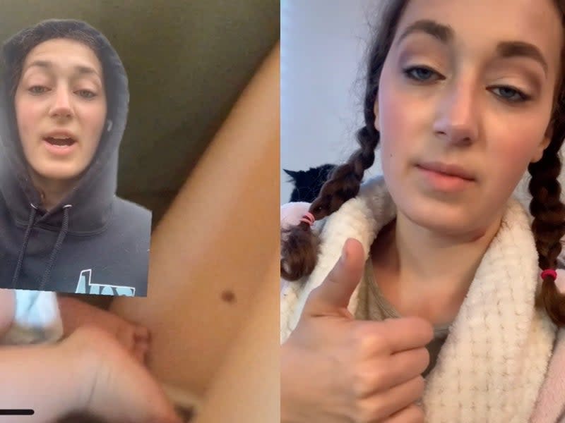 Woman describes cancerous mole to help inform others  (TikTok / @ohhkayypee)