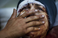 <p>Aida cries as she recovers from severe injuries after the Syrian Army shelled her house in Idlib, north Syria. Aida’s husband and two of her children were killed after their home was shelled, March 10, 2012. This image was one in a series of 20 by AP photographers that won the 2013 Pulitzer Prize in Breaking News Photography. (Photo: Rodrigo Abd/AP) </p>