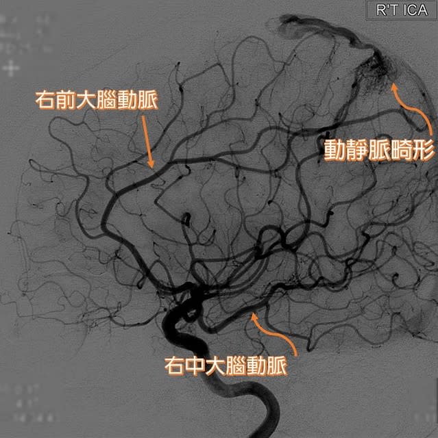 動脈畸形患者因腦內微血管發育不全，腦部動、靜脈交會處有不正常的畸形組織，使動脈直接注入靜脈。