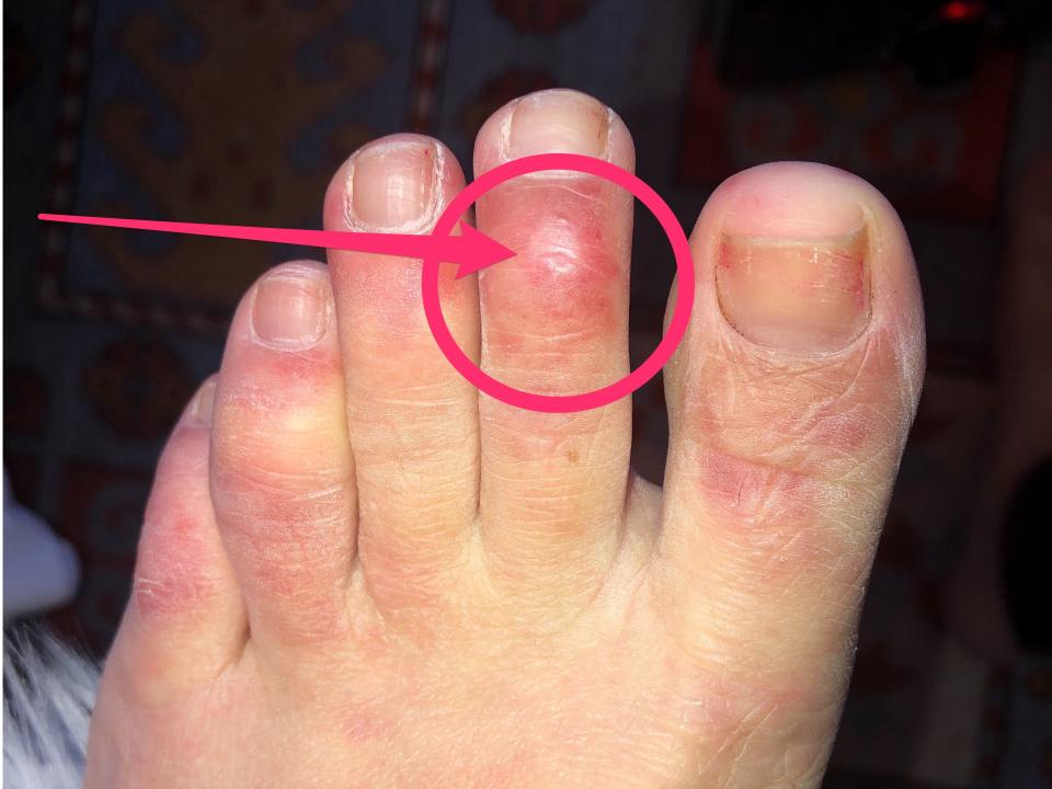 An example of "COVID Toes"