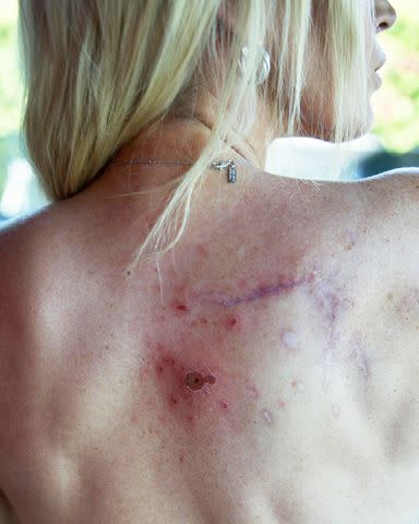 <p>Teddi Mellencamp/Instagram</p> Teddi Mellencamp shares photo of melanoma on her back