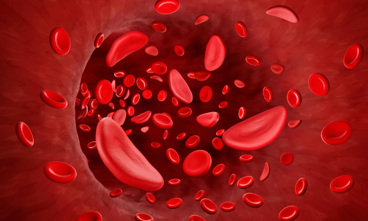 <span>Sickle cells in blood flow. The disease is more common among people of African or Caribbean descent.</span><span>Photograph: Artur Plawgo/Science Photo Library/Getty Images</span>
