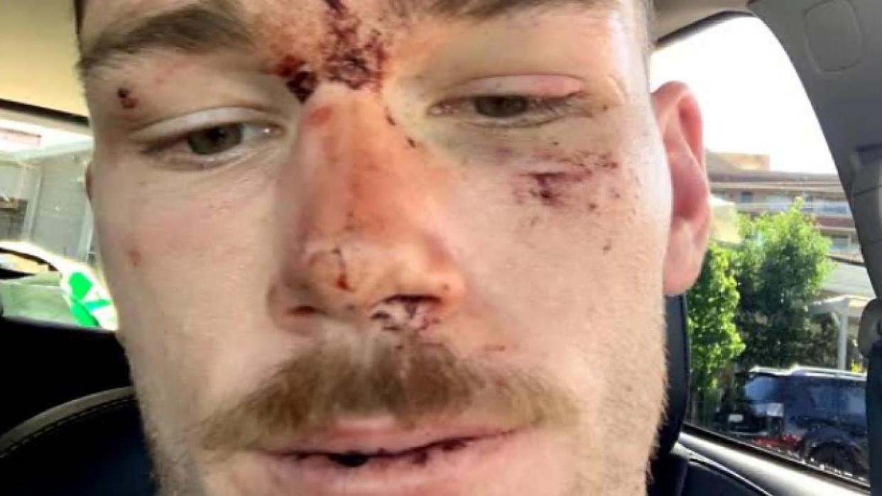 Supplied Editorial Canberra Raiders player Tom Starling after an incident with police on
 the Central Coast. Picture supplied