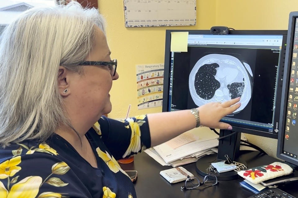 FILE - Dr. Lee Morissette shows an image of lungs damaged by asbestos exposure, at the Center for Asbestos Related Disease, Thursday, April 4, 2024, in Libby, Mont. BNSF Railway attorneys are expected to argue before jurors Friday, April 19, 2024, that the railroad should not be held liable for the lung cancer deaths of two former residents of the asbestos-contaminated Montana town, one of the deadliest sites in the federal Superfund pollution program. (AP Photo/Matthew Brown, File)