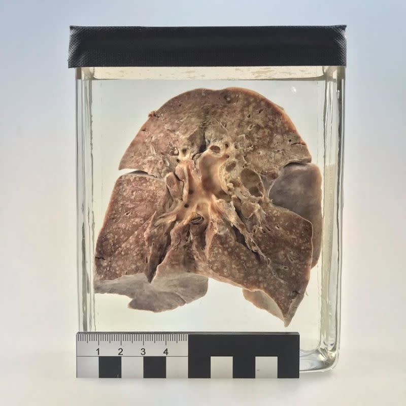 Muestra pulmonar conservada en formalina de una niña de dos años muerta en 1912 por sarampión y no relacionada con el trabajo sobre la gripe española. (Crédito imagen researchgate.net).