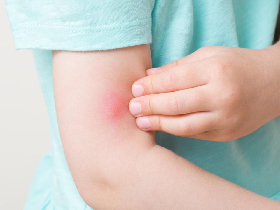 Toddler girl fingers itching red bite of mosquito on arm skin (Getty Images) (Getty Images)