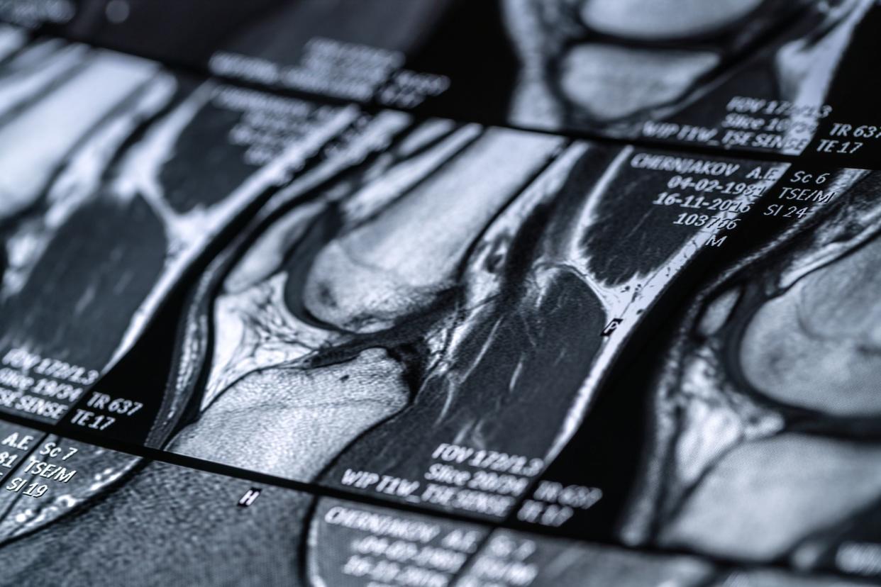 Magnetic resonance imaging (MRI) scan of knee-joint