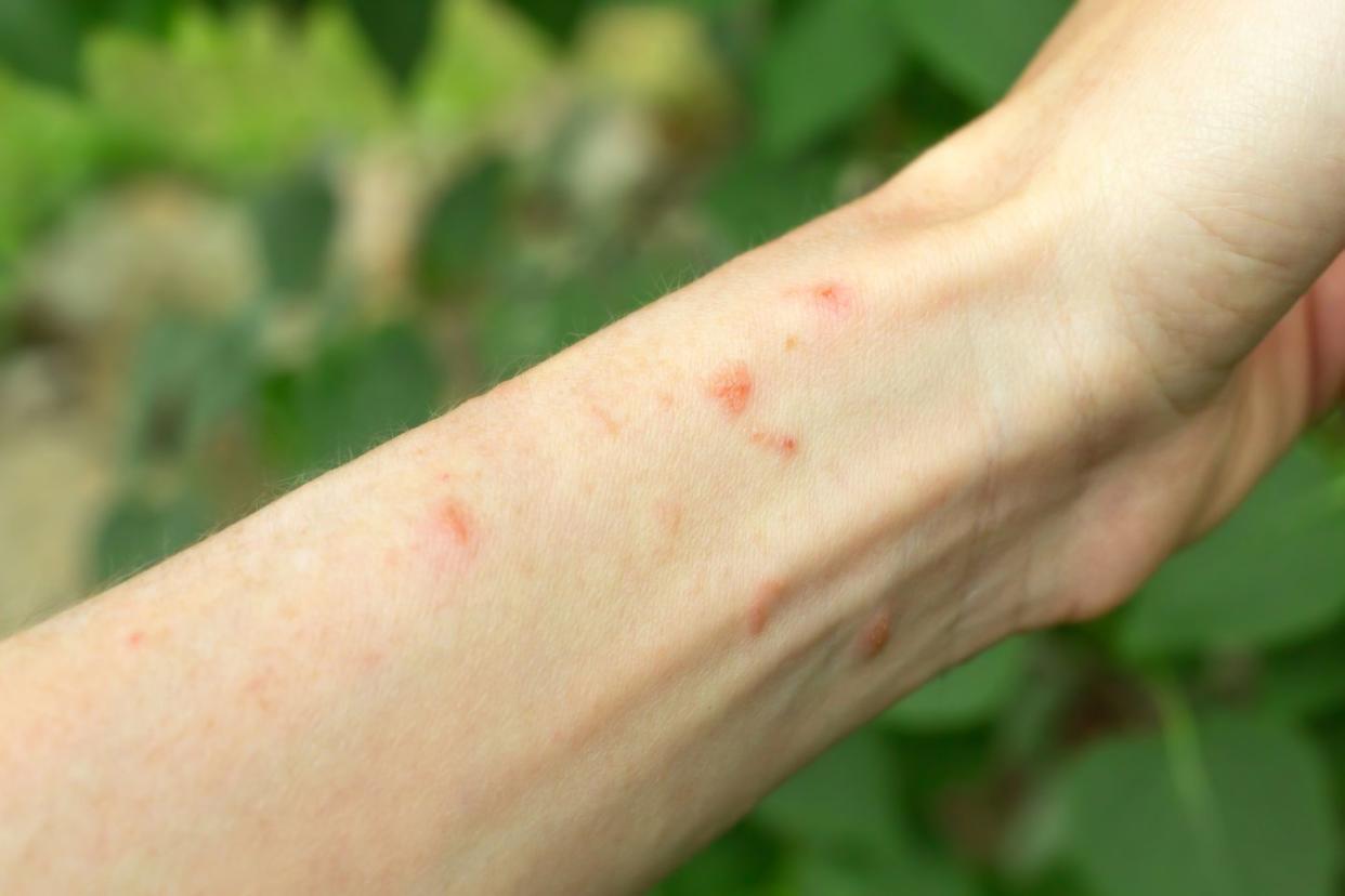 poison ivy rash on arm