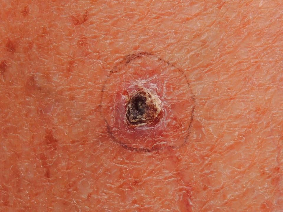 Basal cell carcinoma is one of the most common forms of skin cancer. Universal Images Group via Getty Images