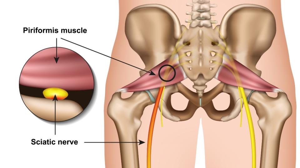 An illustration of the sciatic nerve