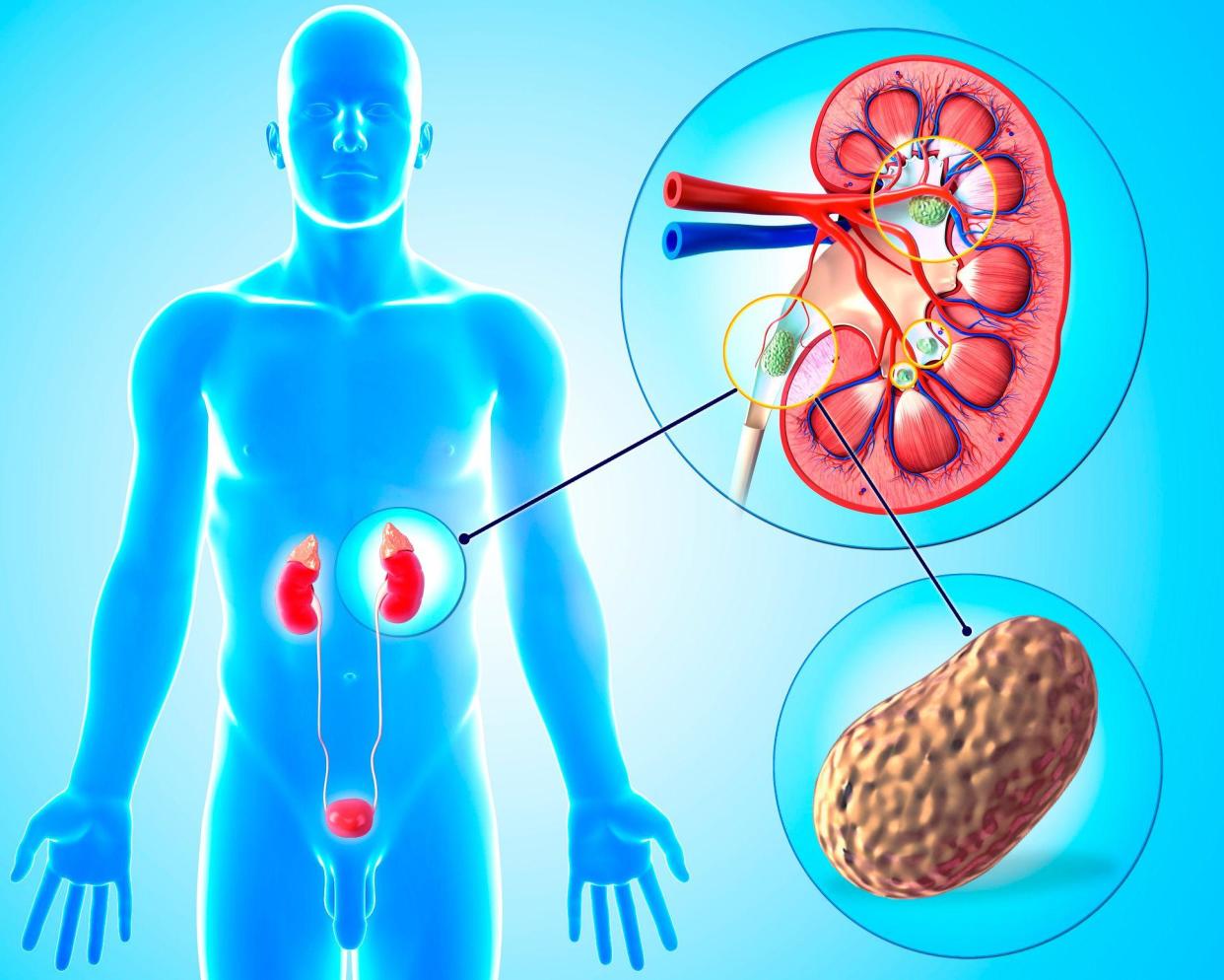 Gráfico muestra la formación de un cálculo renal