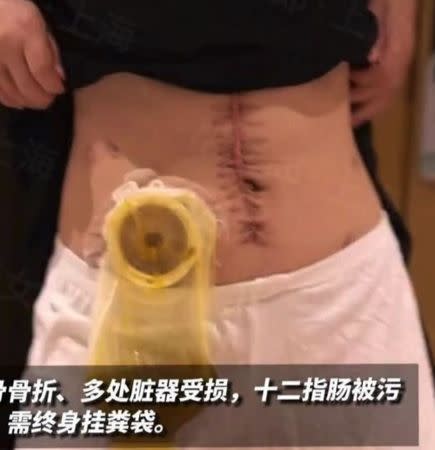 小謝被賀姓丈夫打到腎、肝、肺等內臟均受損傷，十二指腸也被污染，無法排便，必須終身掛著糞袋。   圖：翻攝微博