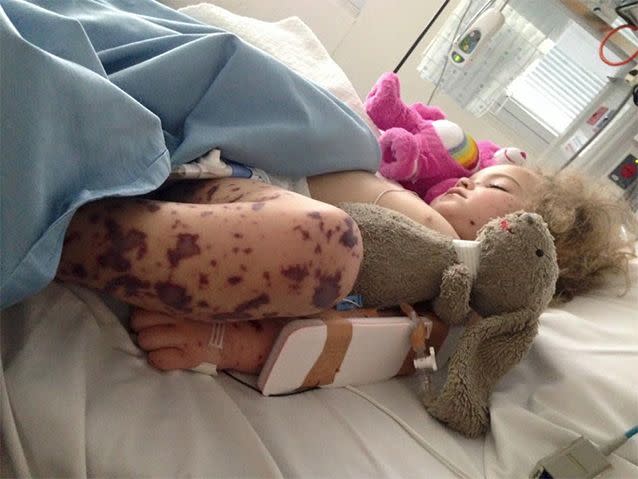 Jazmyn spent a month in hospital after contracting meningococcal B - despite being full vaccinated. Her parents were shocked to discover the vaccination isn't included in normal immunisations. Photo: Facebook/Jazmyn's meningococcal B journey