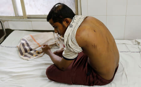 Mohammed Salman, who survived a mob lynching attack which killed his friend Mohammed Azam, displays injuries in a hospital in Hyderabad, India, July 18, 2018. Picture taken July 18, 2018. REUTERS/Danish Siddiqui